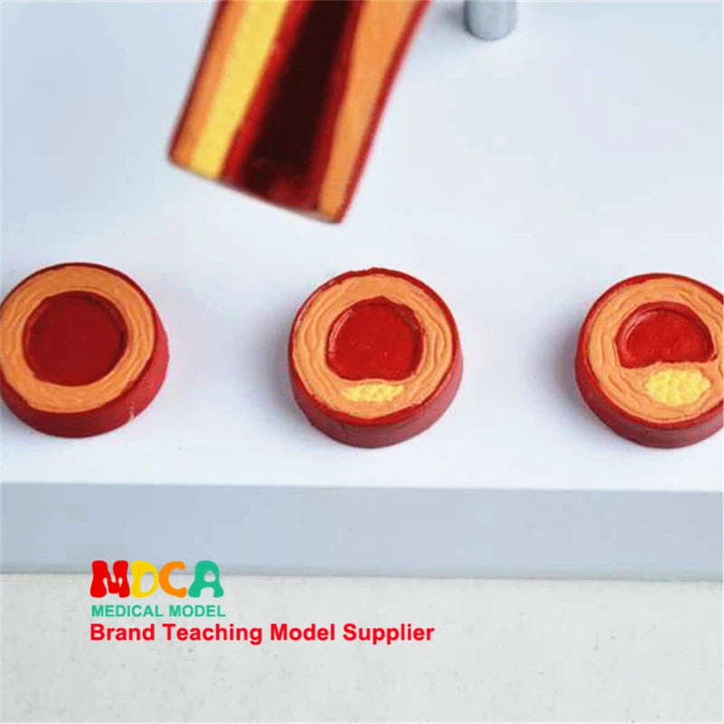 Human Vessel Atherosclerosis Vascular Model Medical Supplies and Equipment Teaching Tool