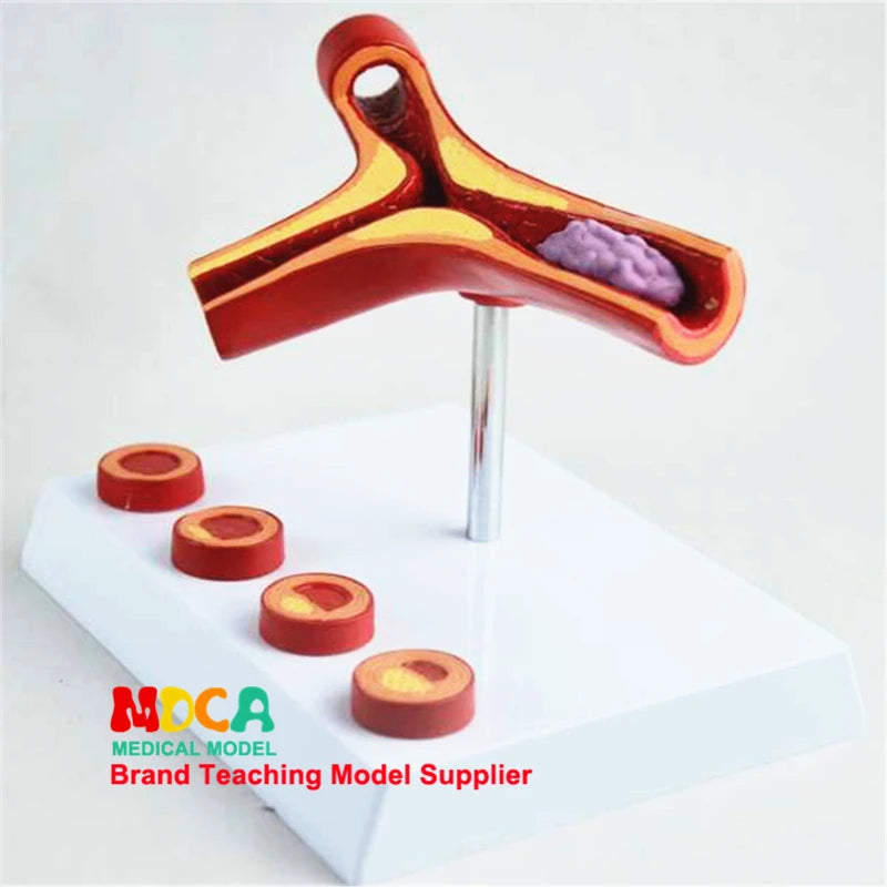 Human Vessel Atherosclerosis Vascular Model Medical Supplies and Equipment Teaching Tool