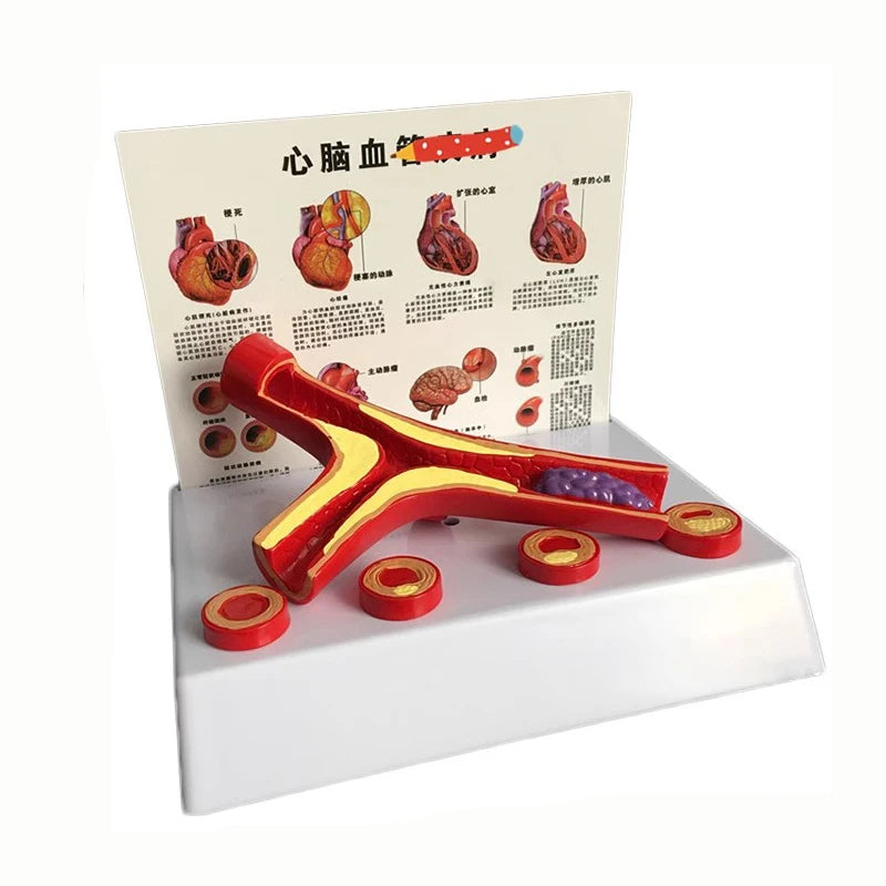 Human Vessel Atherosclerosis Vascular Model Medical Supplies and Equipment Teaching Tool